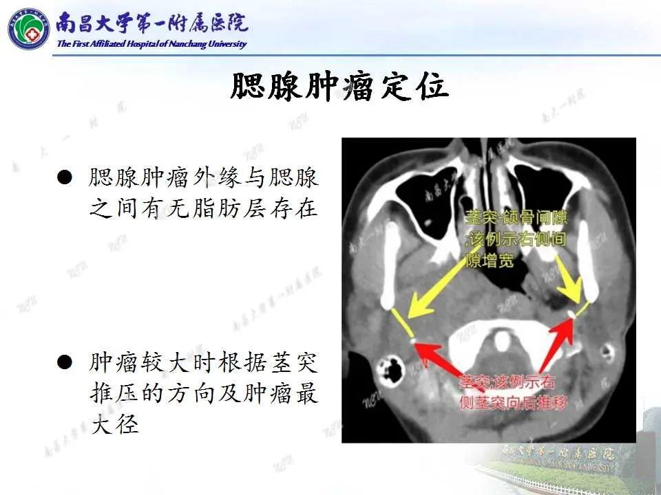 【PPT】腮腺肿瘤CT诊断分析思路-8