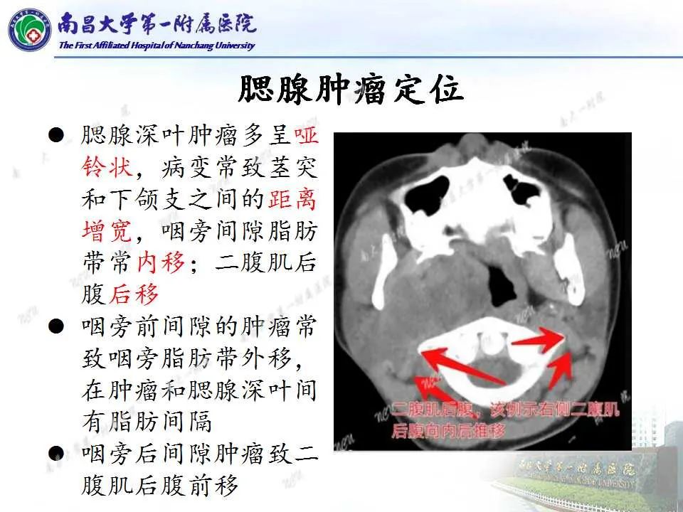 【PPT】腮腺肿瘤CT诊断分析思路-10