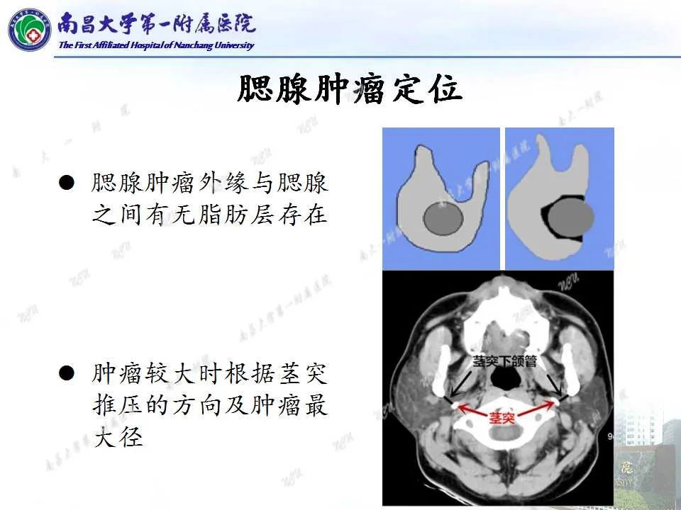 【PPT】腮腺肿瘤CT诊断分析思路-7