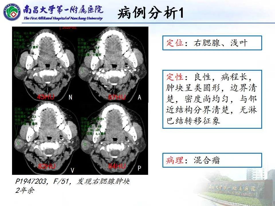 【PPT】腮腺肿瘤CT诊断分析思路-18