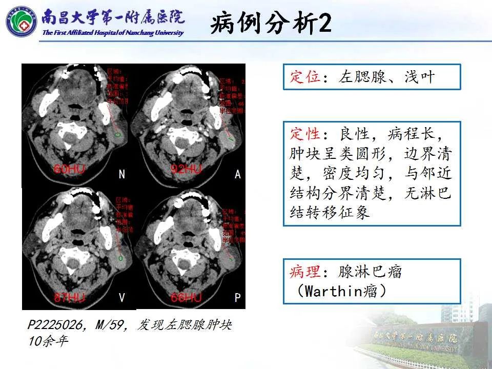 【PPT】腮腺肿瘤CT诊断分析思路-20