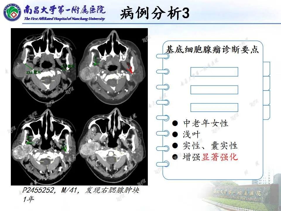 【PPT】腮腺肿瘤CT诊断分析思路-23