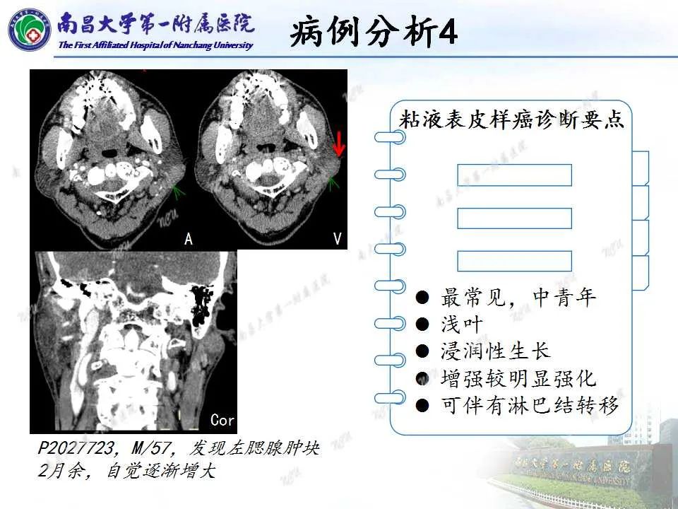 【PPT】腮腺肿瘤CT诊断分析思路-25