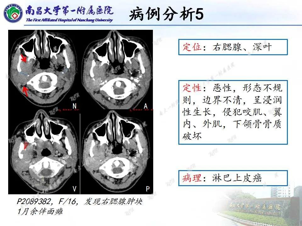 【PPT】腮腺肿瘤CT诊断分析思路-26