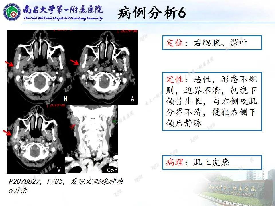 【PPT】腮腺肿瘤CT诊断分析思路-28