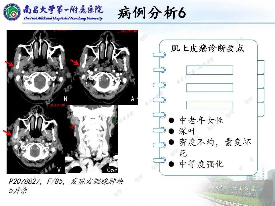 【PPT】腮腺肿瘤CT诊断分析思路-29