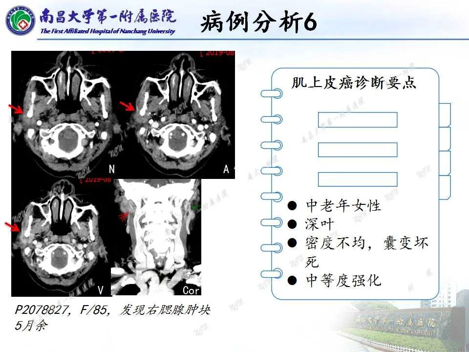 【PPT】腮腺肿瘤CT诊断分析思路-29