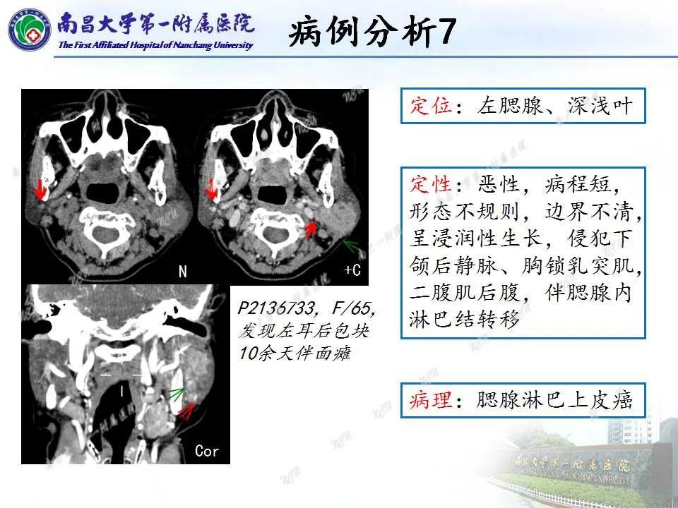 【PPT】腮腺肿瘤CT诊断分析思路-31