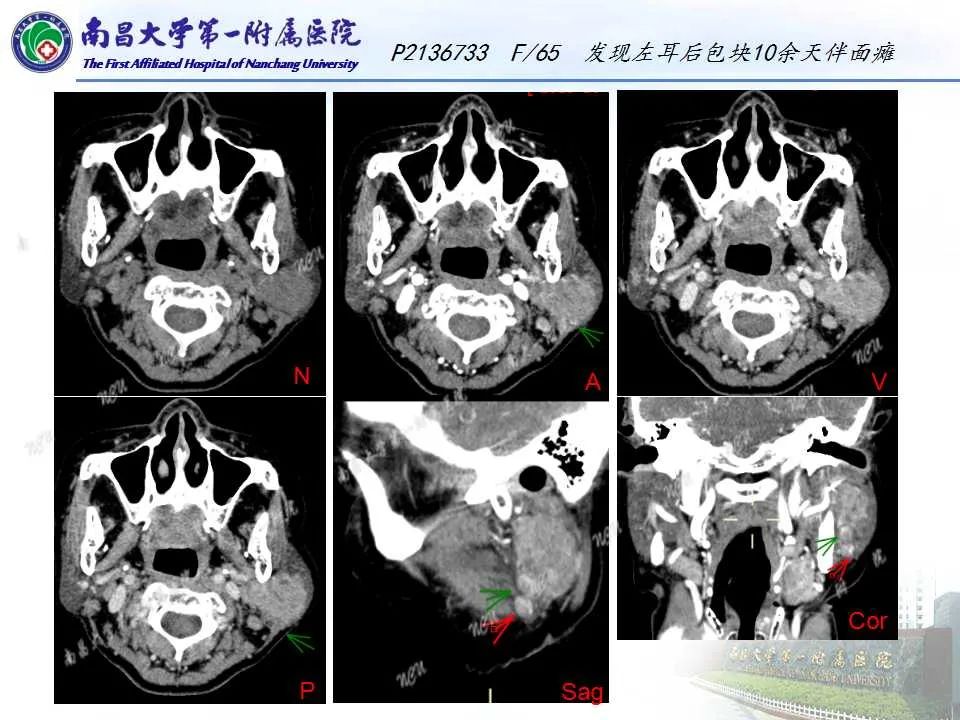 【PPT】腮腺肿瘤CT诊断分析思路-2