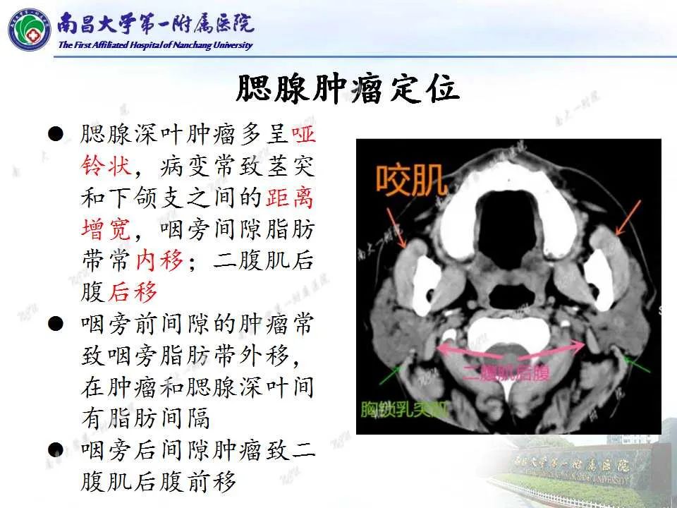 【PPT】腮腺肿瘤CT诊断分析思路-4