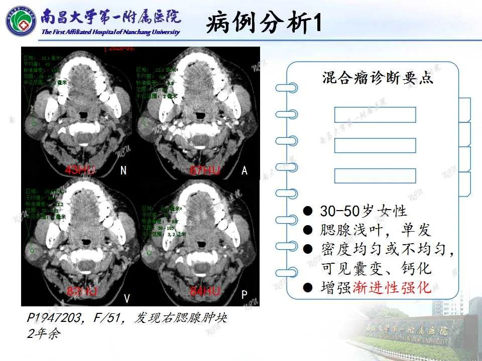 【PPT】腮腺肿瘤CT诊断分析思路-7