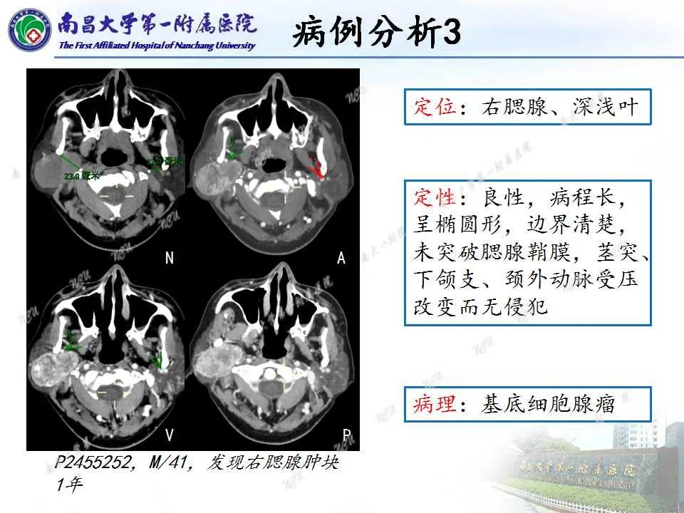 【PPT】腮腺肿瘤CT诊断分析思路-9