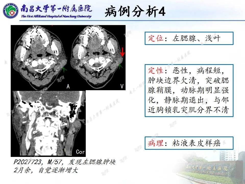 【PPT】腮腺肿瘤CT诊断分析思路-10