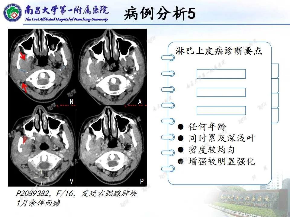 【PPT】腮腺肿瘤CT诊断分析思路-11