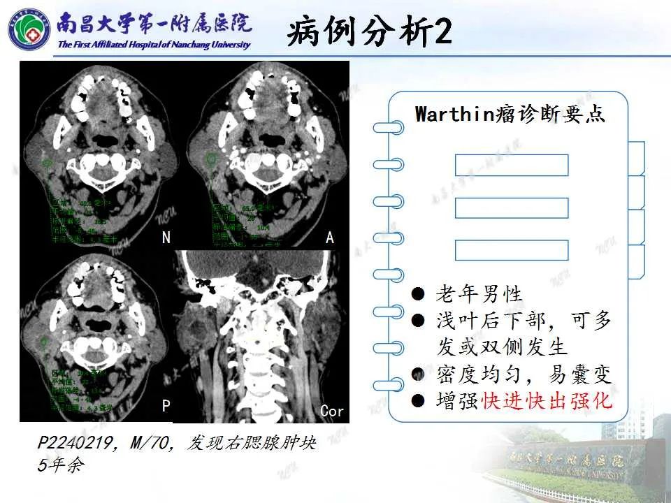 【PPT】腮腺肿瘤CT诊断分析思路-2