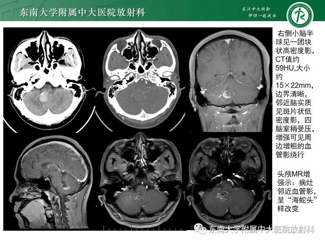 【PPT】颅内海绵状血管畸形-2