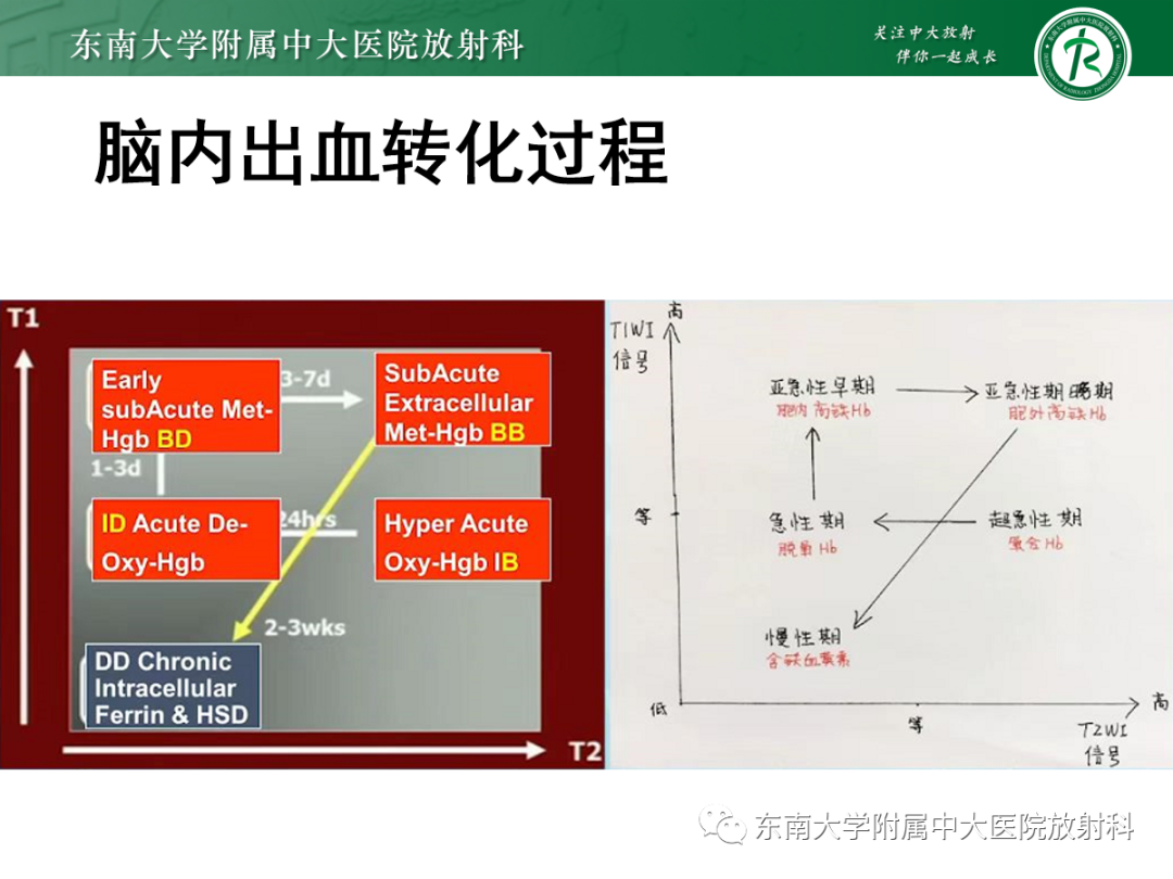 【PPT】颅内海绵状血管畸形-11