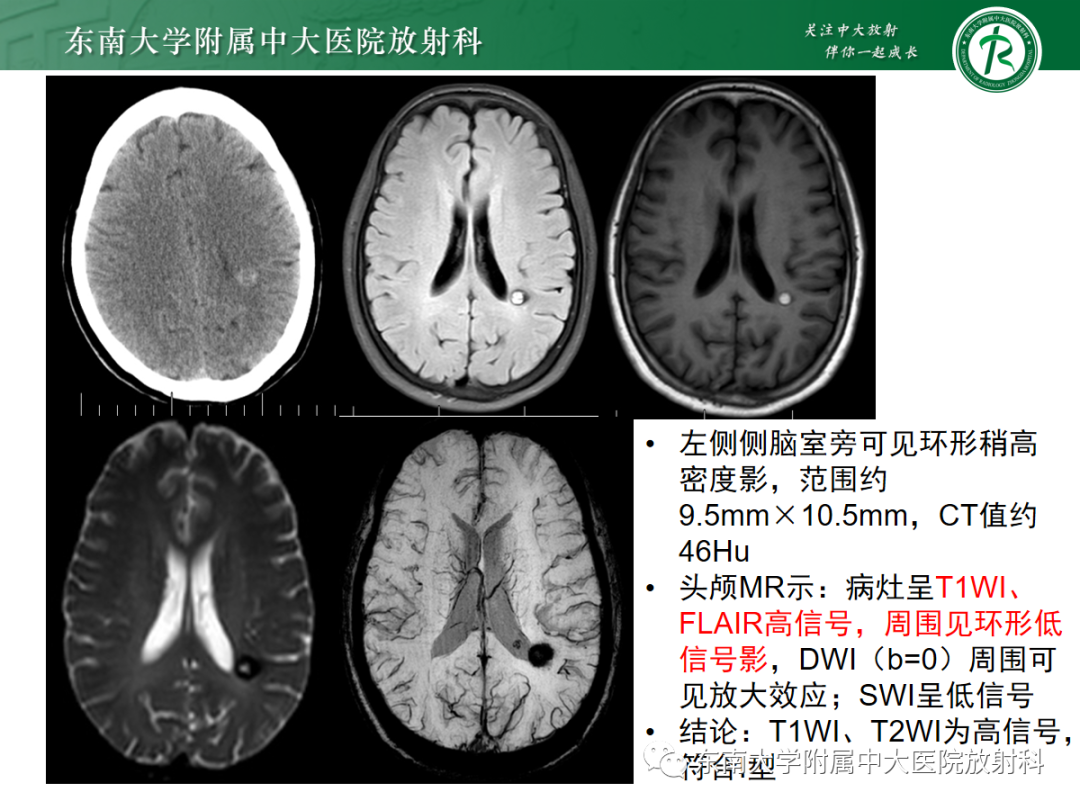 【PPT】颅内海绵状血管畸形-14