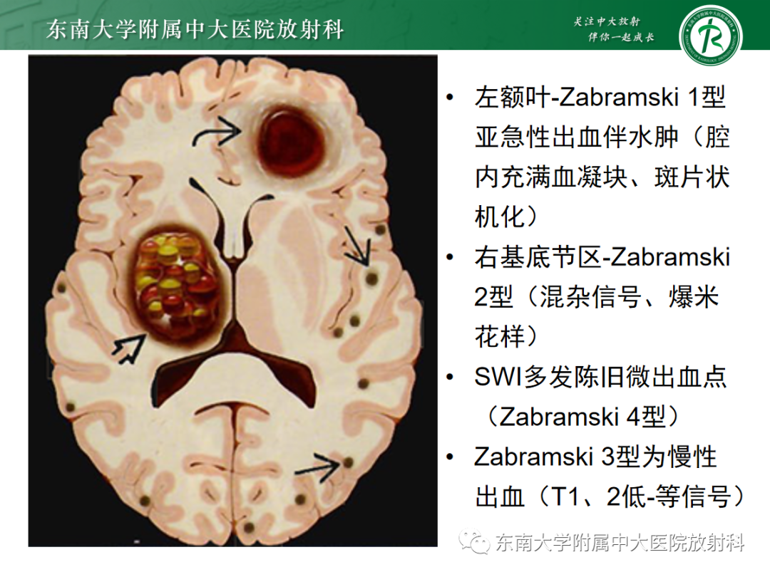 【PPT】颅内海绵状血管畸形-13