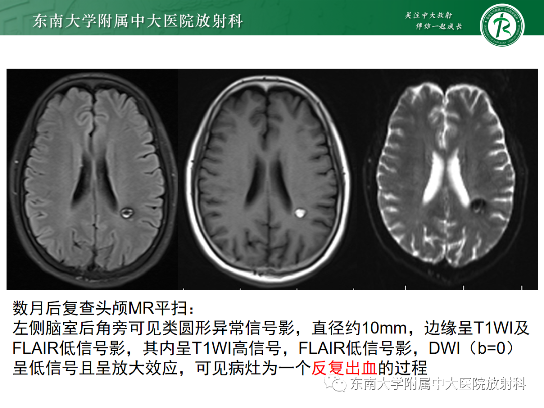 【PPT】颅内海绵状血管畸形-15
