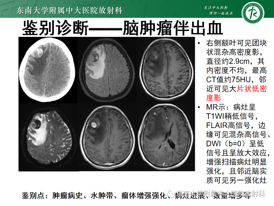 【PPT】颅内海绵状血管畸形-17