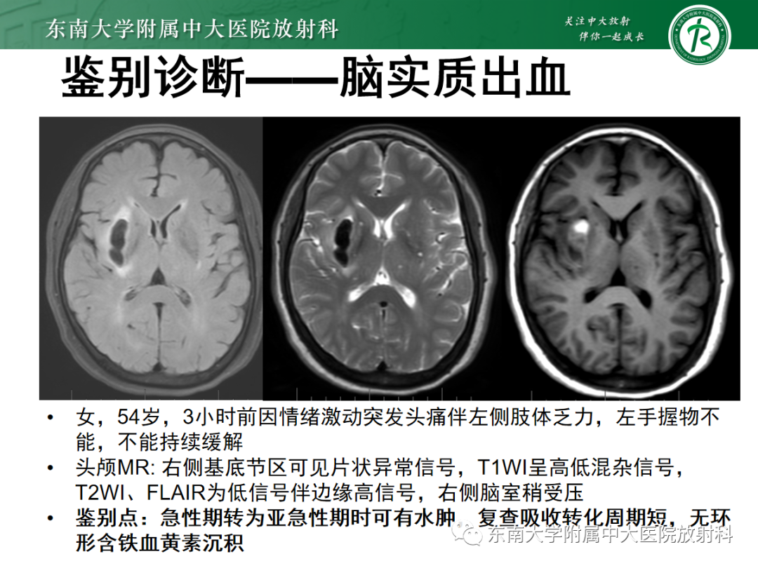 【PPT】颅内海绵状血管畸形-16