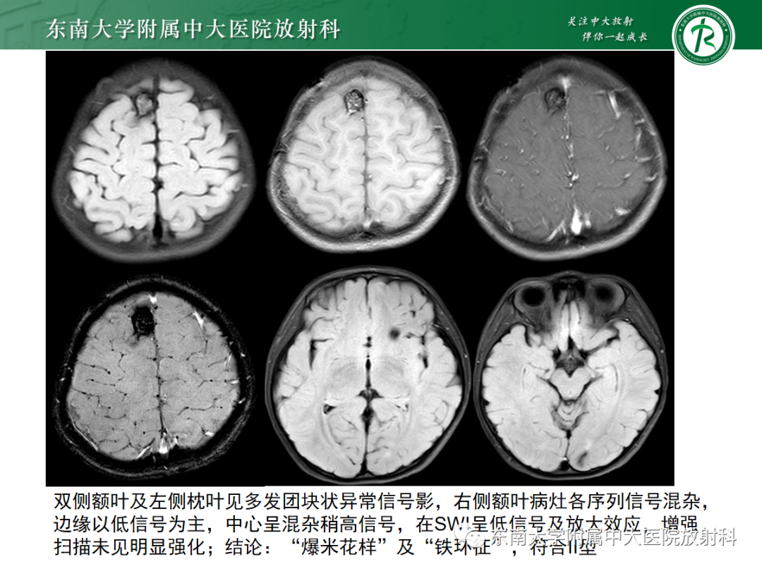 【PPT】颅内海绵状血管畸形-19