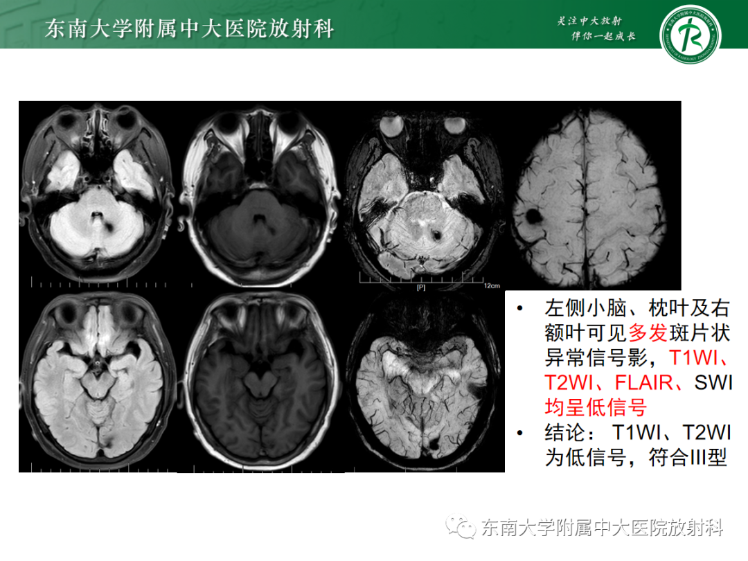 【PPT】颅内海绵状血管畸形-21