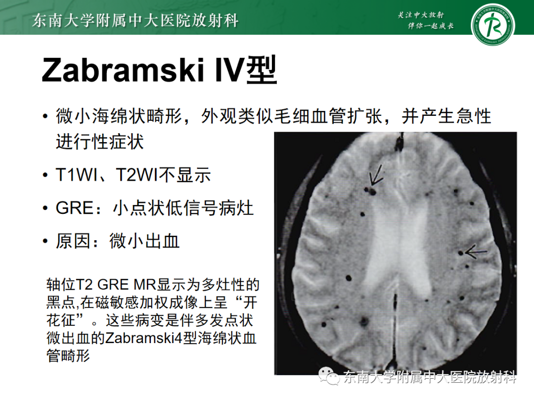 【PPT】颅内海绵状血管畸形-22
