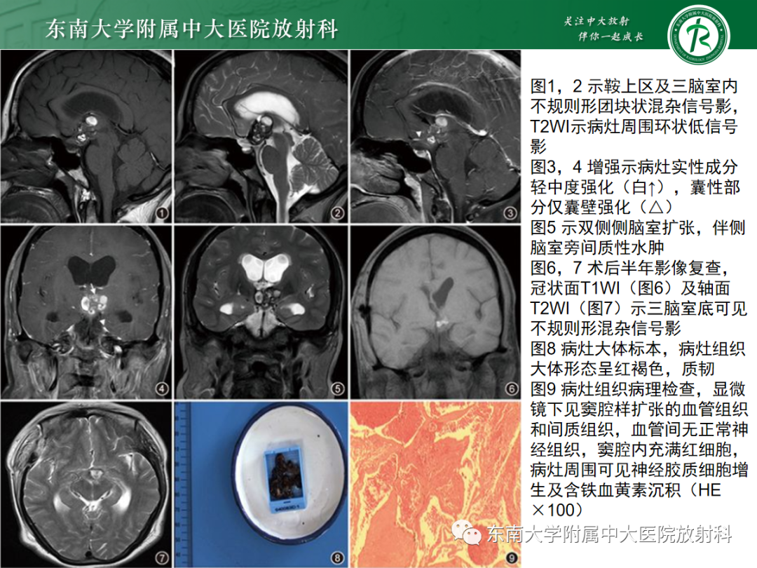 【PPT】颅内海绵状血管畸形-24