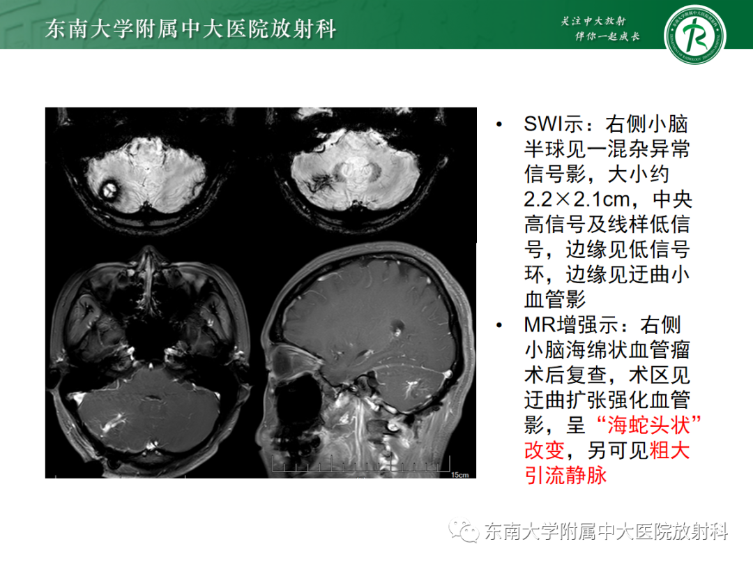 【PPT】颅内海绵状血管畸形-28