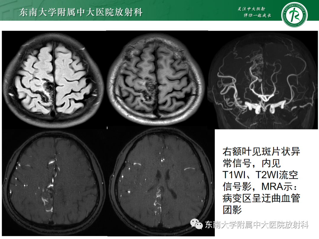 【PPT】颅内海绵状血管畸形-31