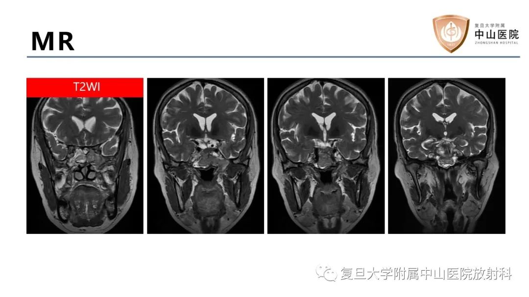 【病例】蝶窦异位垂体腺瘤1例CT及MR-4