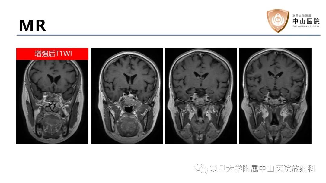 【病例】蝶窦异位垂体腺瘤1例CT及MR-6