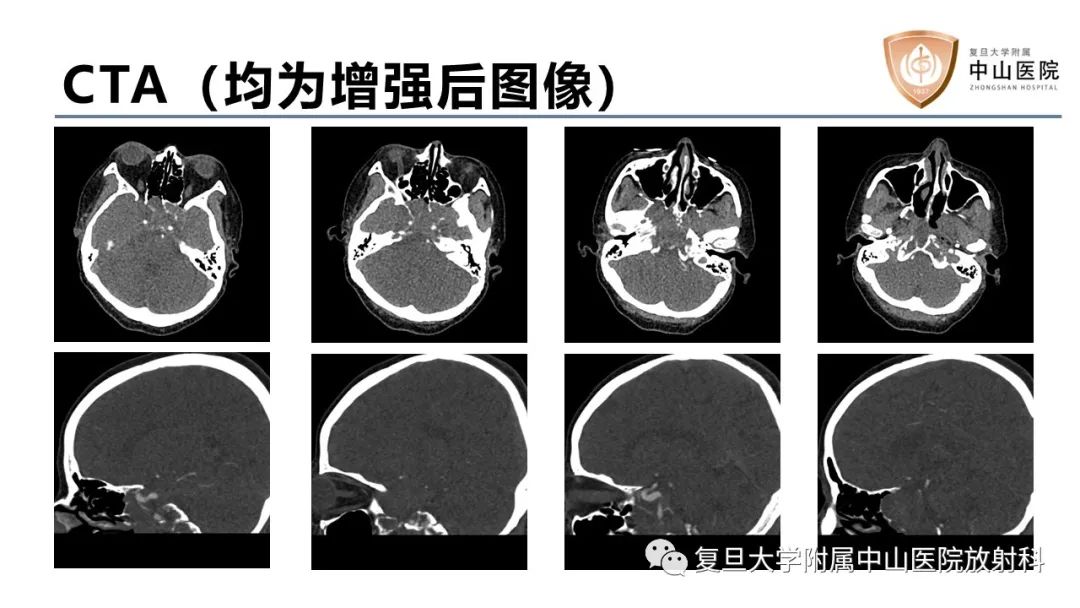 【病例】蝶窦异位垂体腺瘤1例CT及MR-3