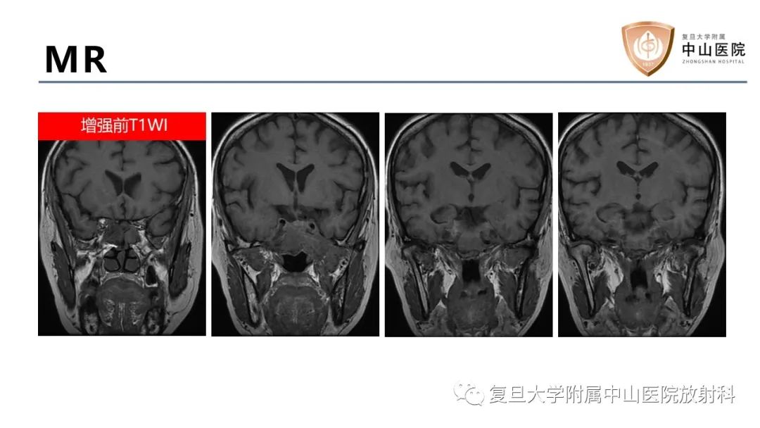 【病例】蝶窦异位垂体腺瘤1例CT及MR-5