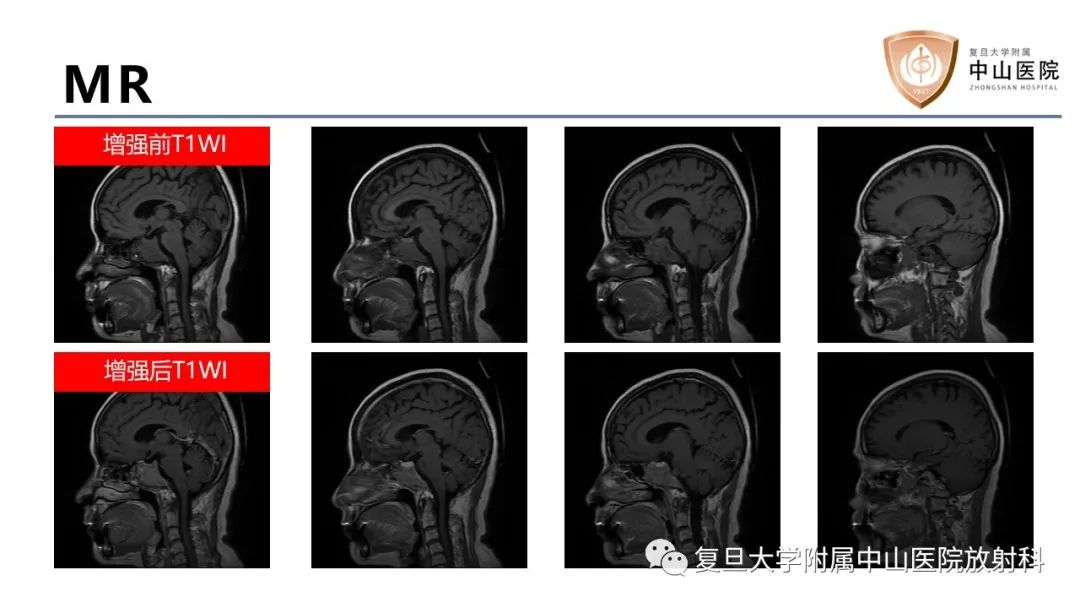 【病例】蝶窦异位垂体腺瘤1例CT及MR-7