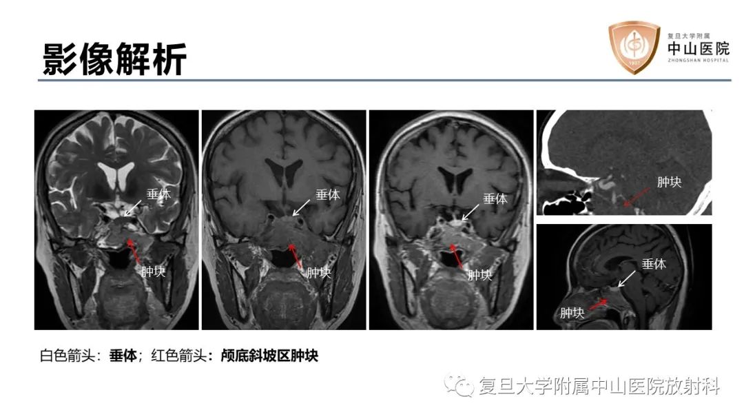 【病例】蝶窦异位垂体腺瘤1例CT及MR-10
