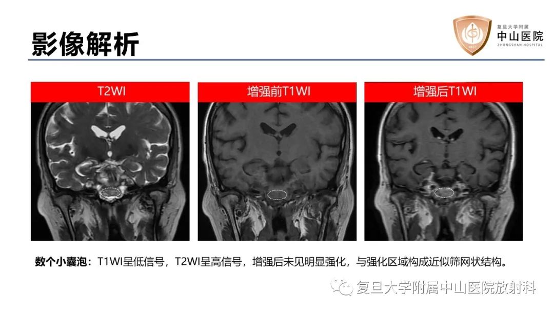 【病例】蝶窦异位垂体腺瘤1例CT及MR-11