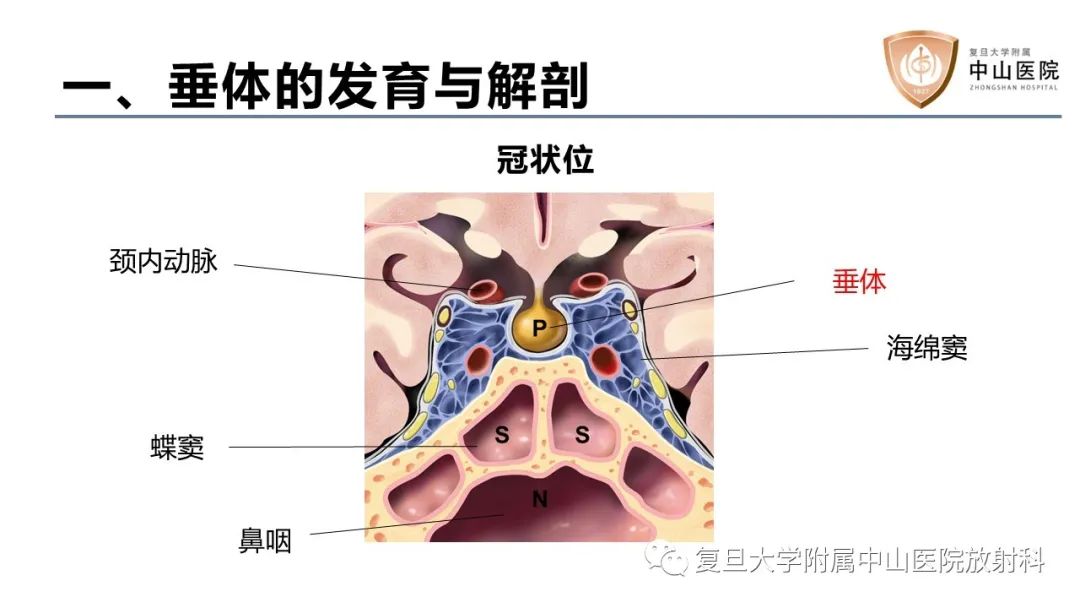 【病例】蝶窦异位垂体腺瘤1例CT及MR-15