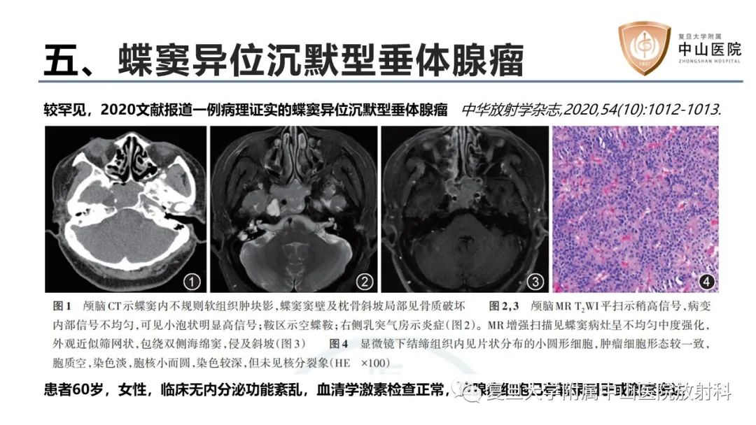 【病例】蝶窦异位垂体腺瘤1例CT及MR-27