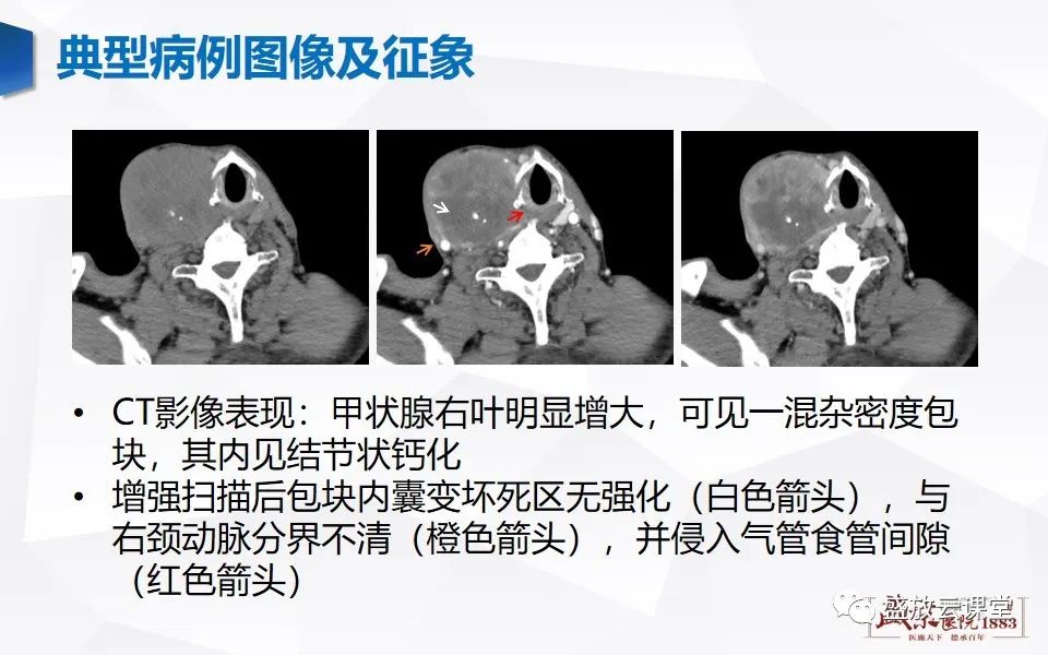 【病例】甲状腺癌1例CT影像鉴别-4