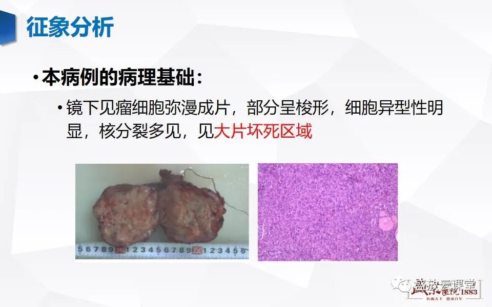 【病例】甲状腺癌1例CT影像鉴别-6