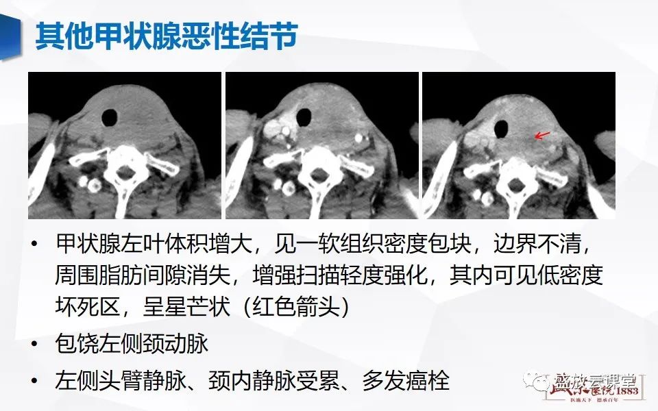 【病例】甲状腺癌1例CT影像鉴别-15