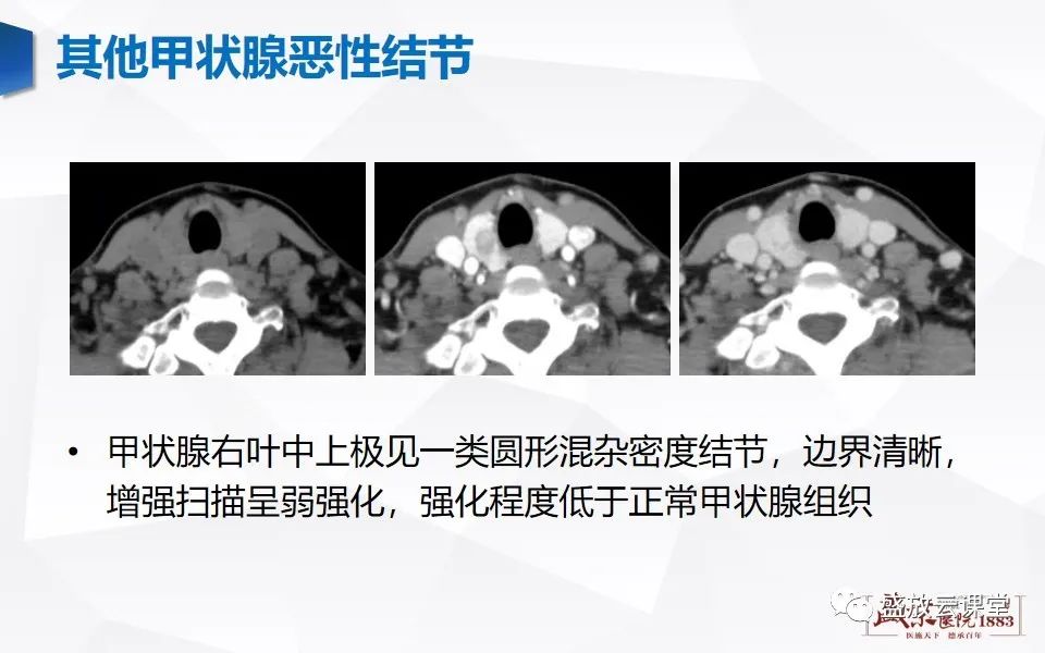 【病例】甲状腺癌1例CT影像鉴别-18