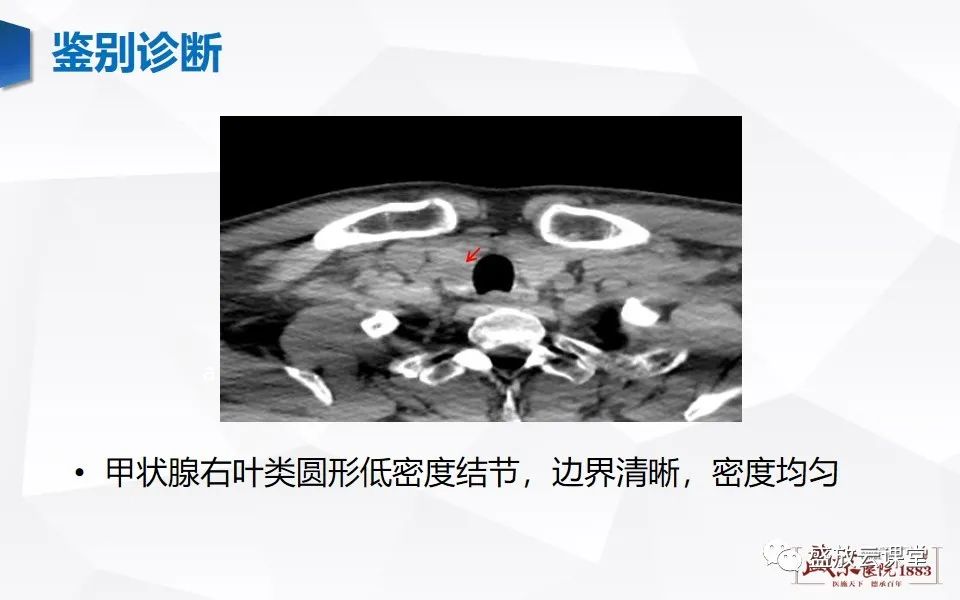 【病例】甲状腺癌1例CT影像鉴别-24