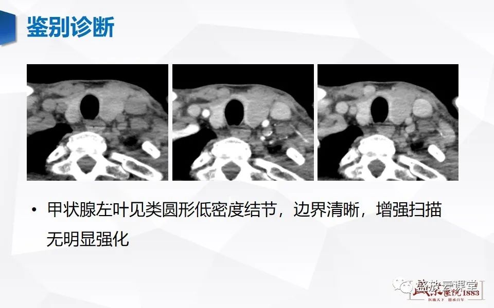 【病例】甲状腺癌1例CT影像鉴别-21