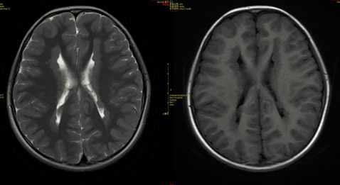 八个病例带你看懂脑灰质异位的三种类型-7