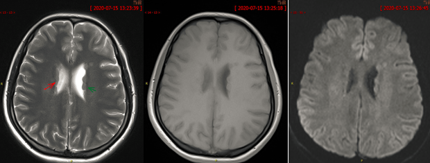 八个病例带你看懂脑灰质异位的三种类型-5