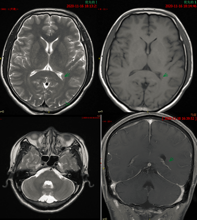 八个病例带你看懂脑灰质异位的三种类型-4